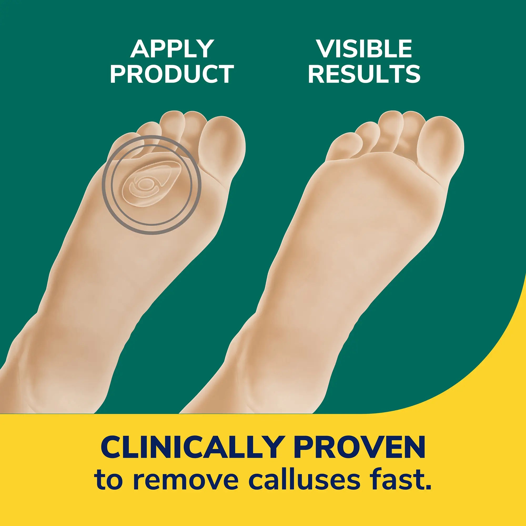 Callus Removers Seal & Heal Bandage with Hydrogel Technology - Image 4