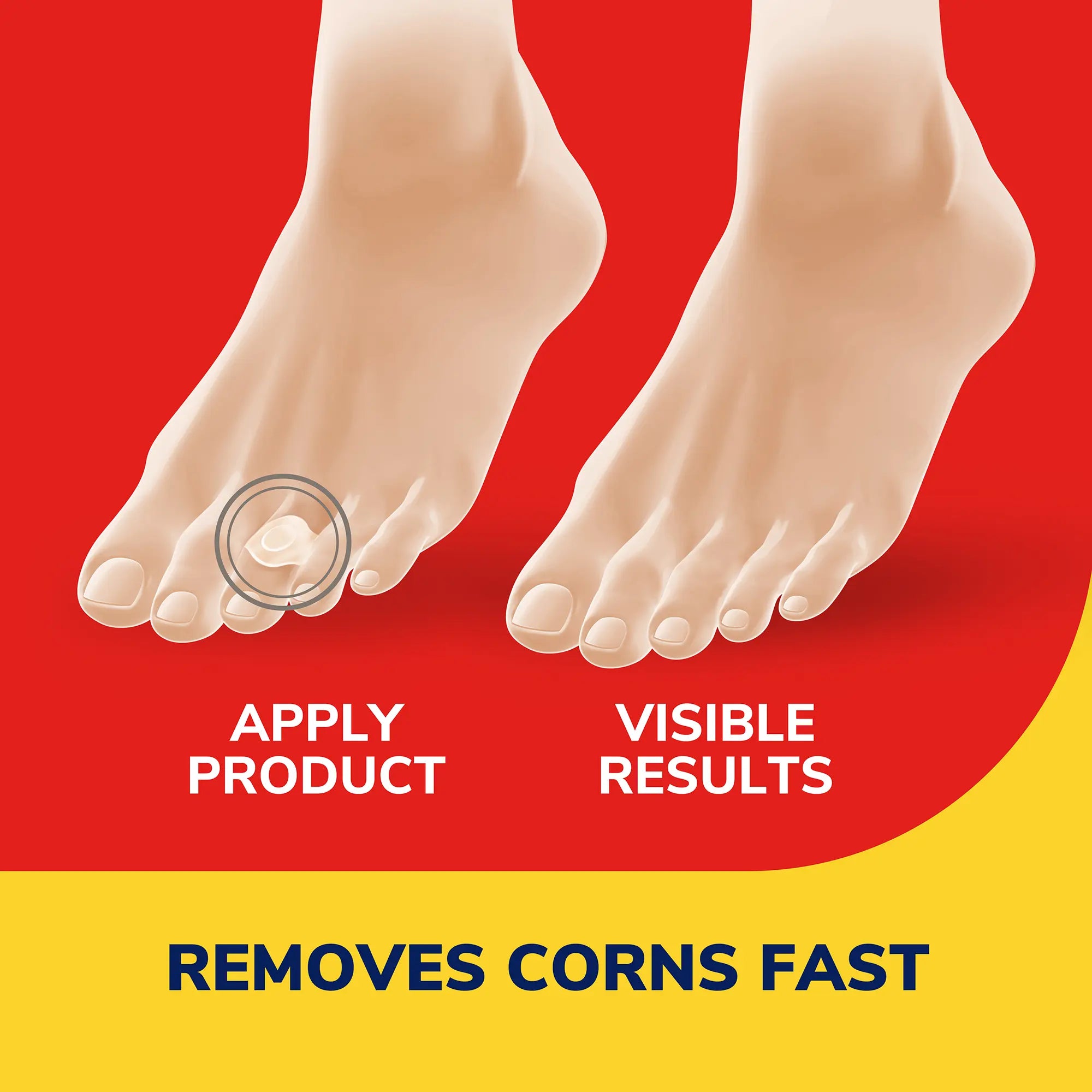 Corn Removers - Image 3