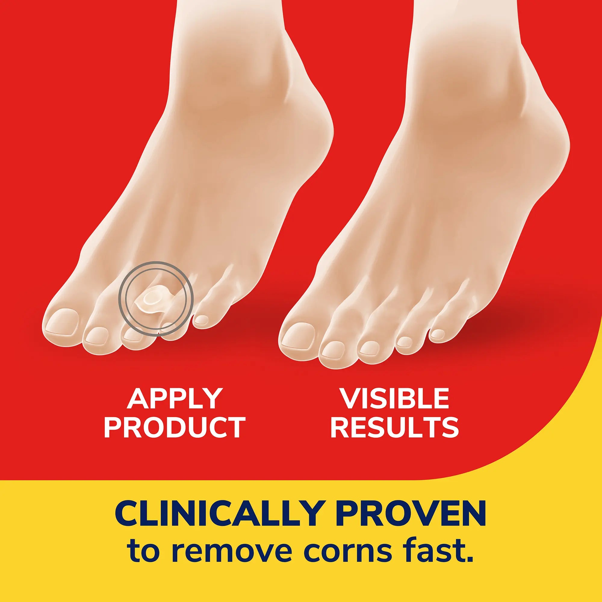 Corn Removers Seal & Heal Bandage with Hydrogel Technology - Image 4