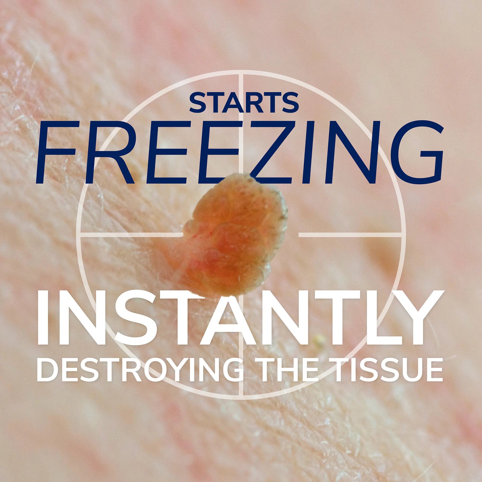 Freeze Away? Skin Tag Remover - Image 5